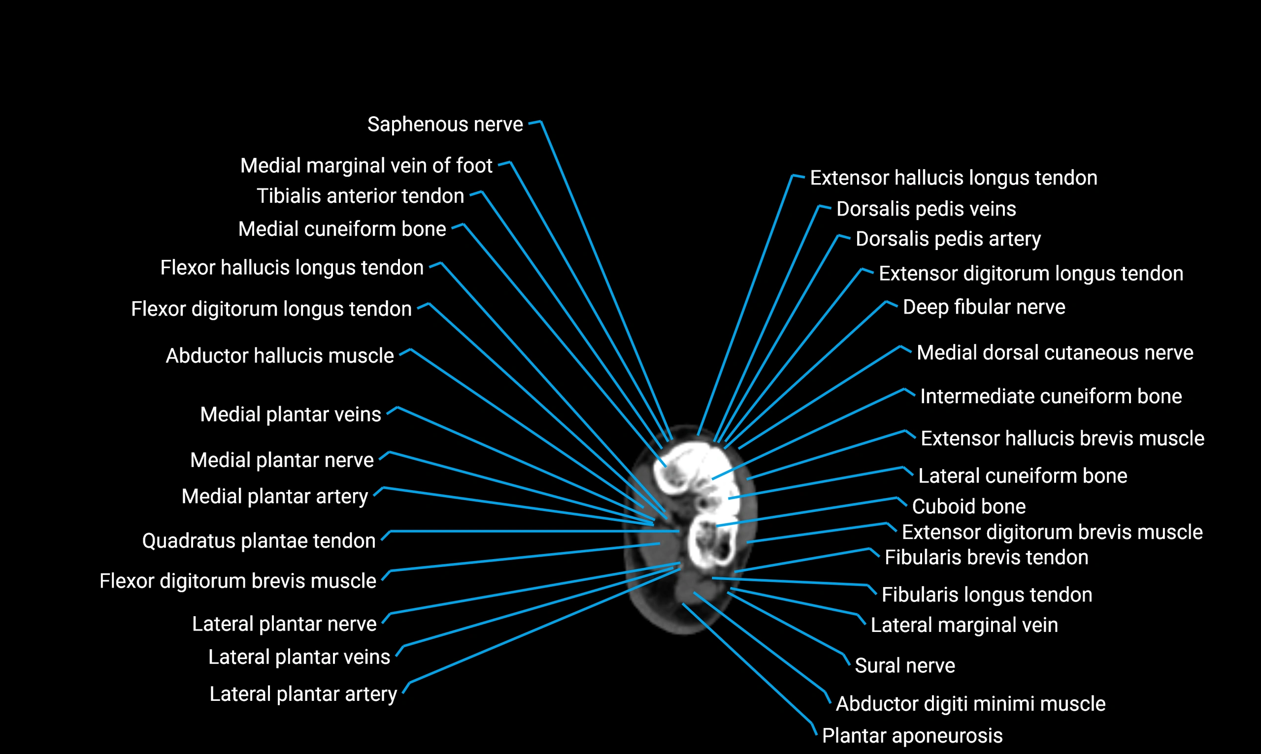 CT lower limb axial cross sectional anatomy labelled image 179 (2).webp